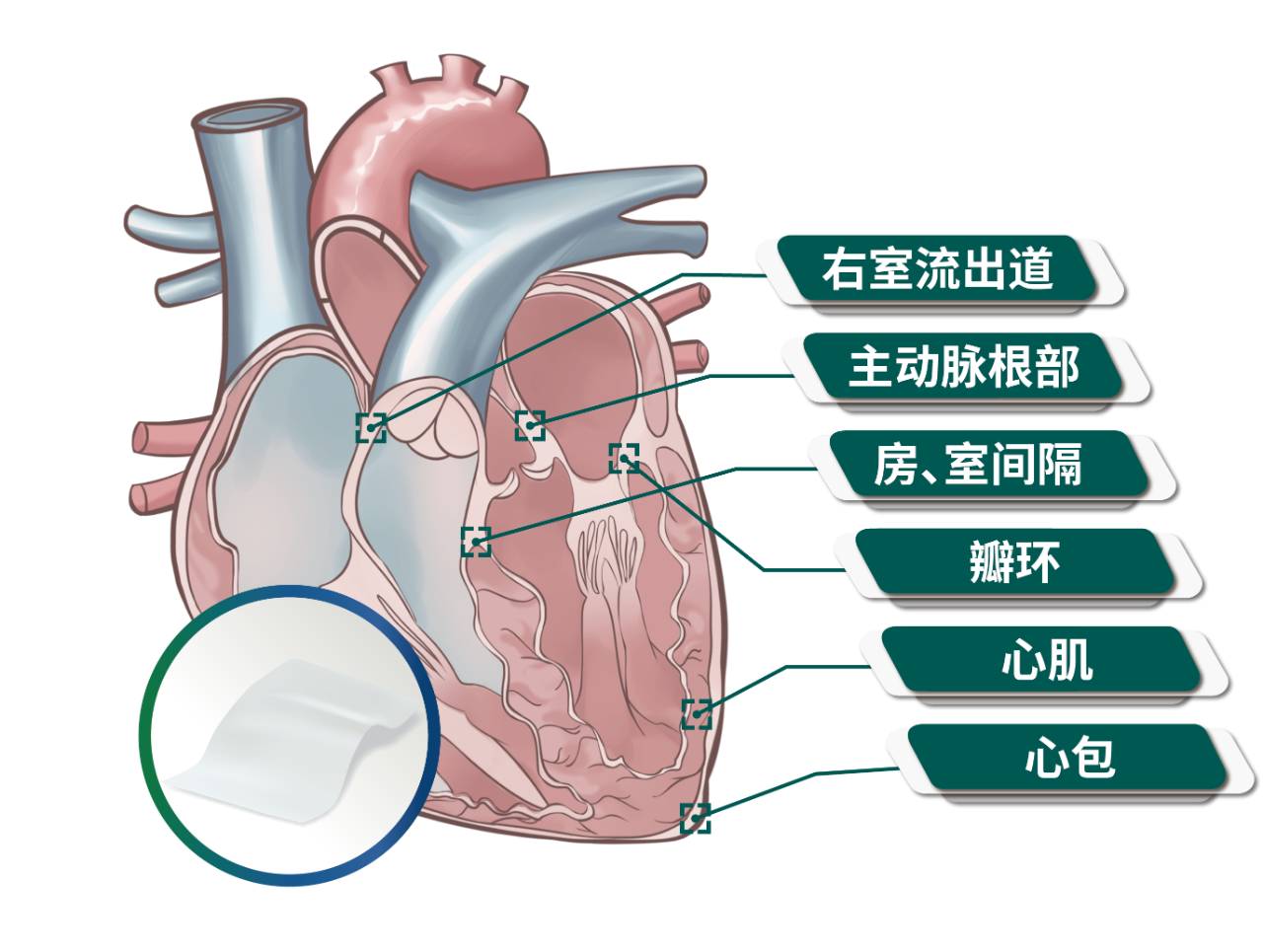 中國(guó)首創(chuàng)“V”形補(bǔ)片技術(shù)治療完全性房室間隔缺損