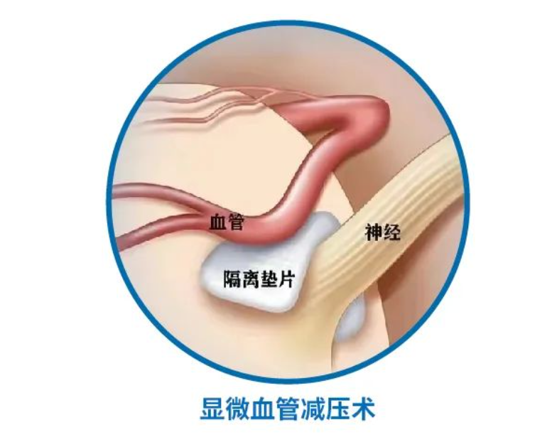 微血管減壓術(shù)在面肌痙攣患者中的應(yīng)用